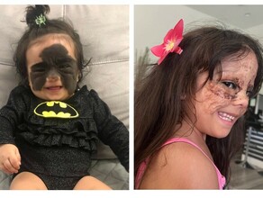 Хирургонколог девочке с маской Бэтмена грозила меланома кожи