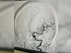 Современный вид лечения при ишемическом инсульте внедряют в Амурской областной больнице