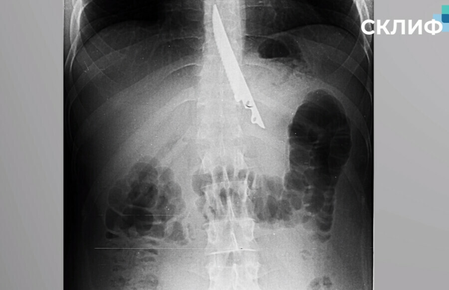 Мужчина случайно проглотил нож которым пытались протолкнуть мясо видео